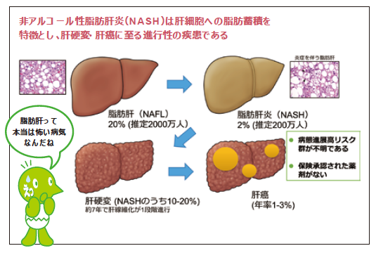 図：脂肪肝、肝炎、肝硬変、肝癌
