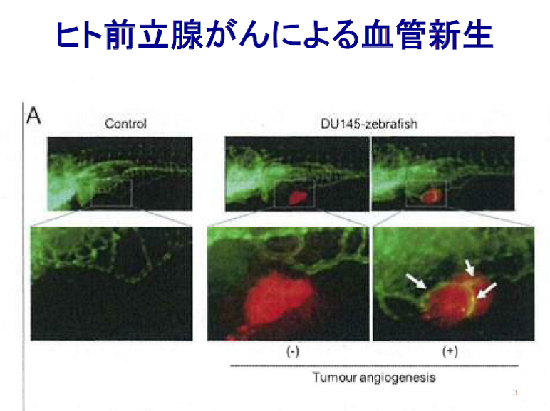 ヒト前立腺がんによる血管新生