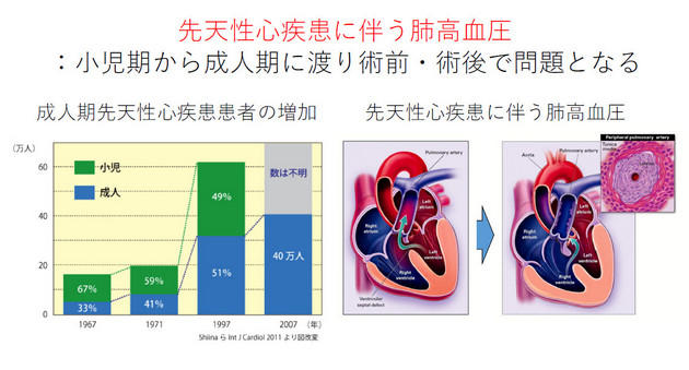 先天性心疾患に伴う肺高血圧