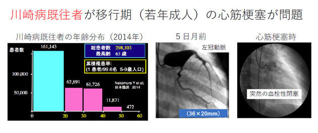 川崎病既往者が移行期（若年成人）の心筋梗塞が問題